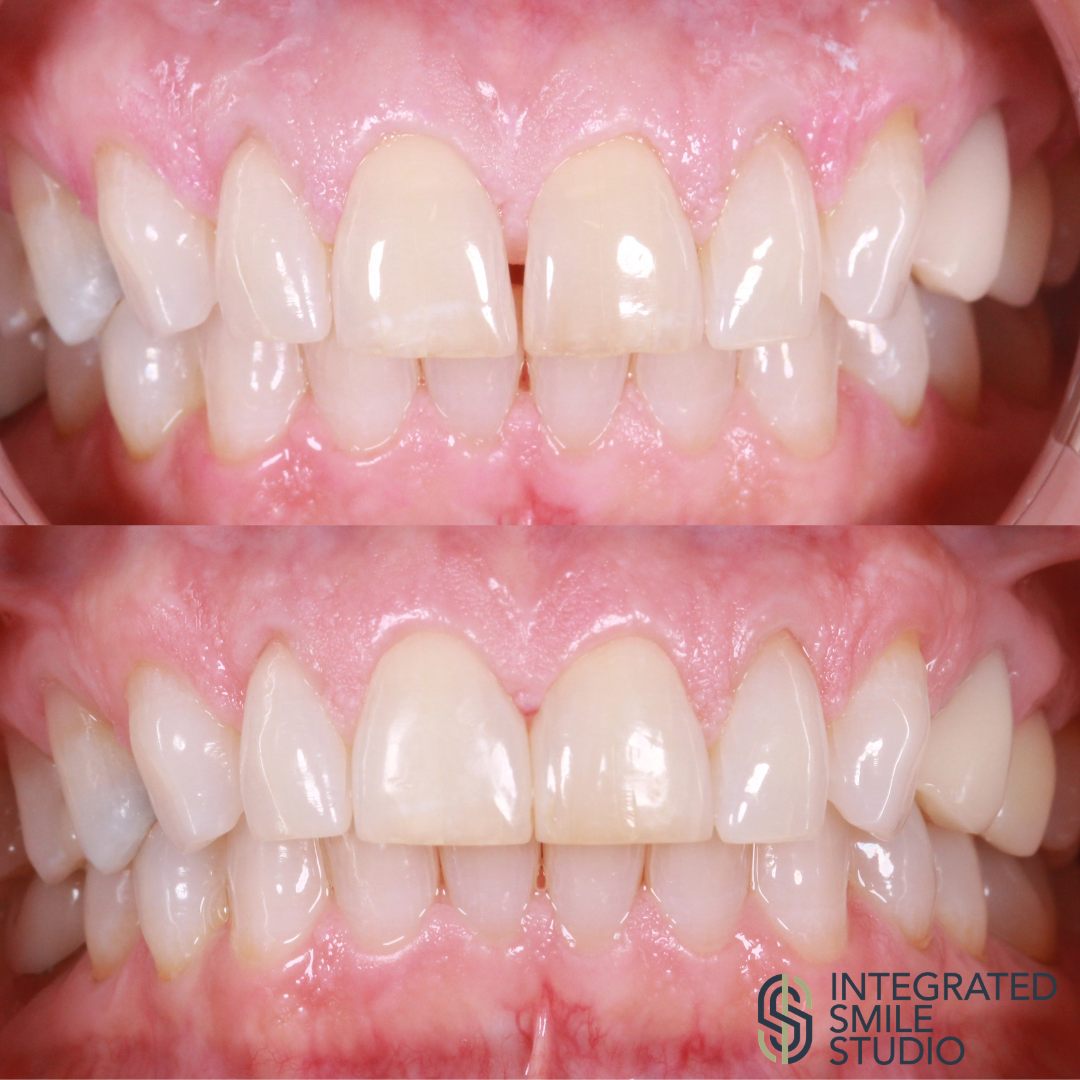 Diastema closure before and after - Integrated Smile Studio