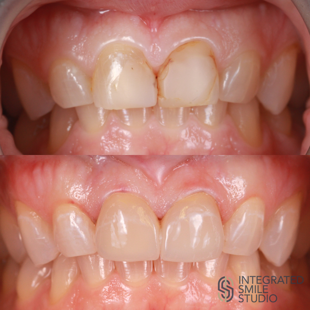 Diastema closure before and after - Integrated Smile Studio