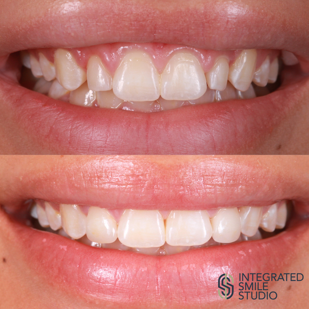 Diastema closure before and after - Integrated Smile Studio
